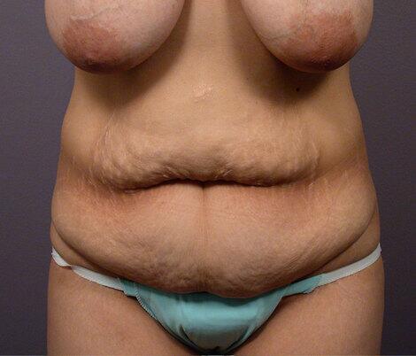 Breast Reduction (for Women) Before & After Image