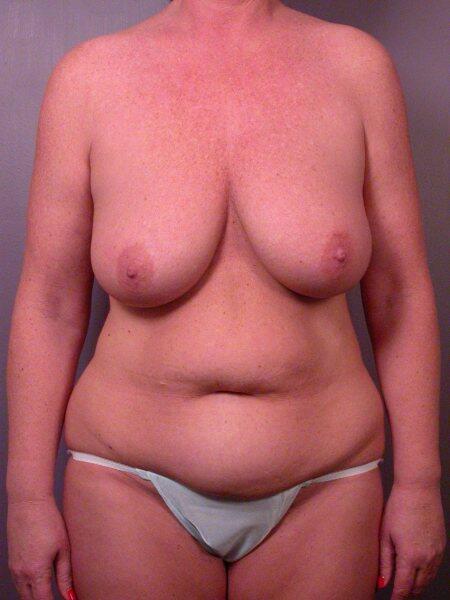 Breast Reduction (for Women) Before & After Image