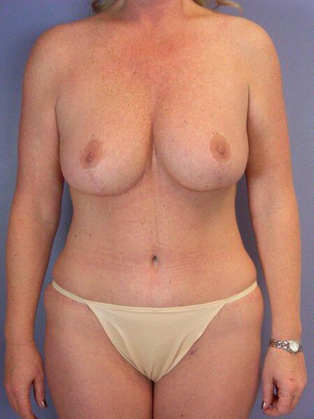 Breast Reduction (for Women) Before & After Image