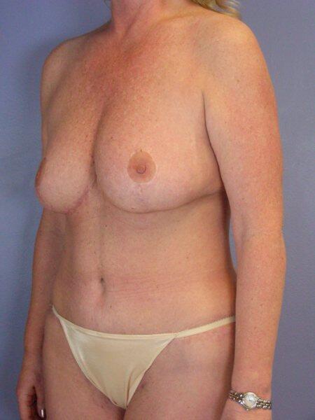 Breast Reduction (for Women) Before & After Image