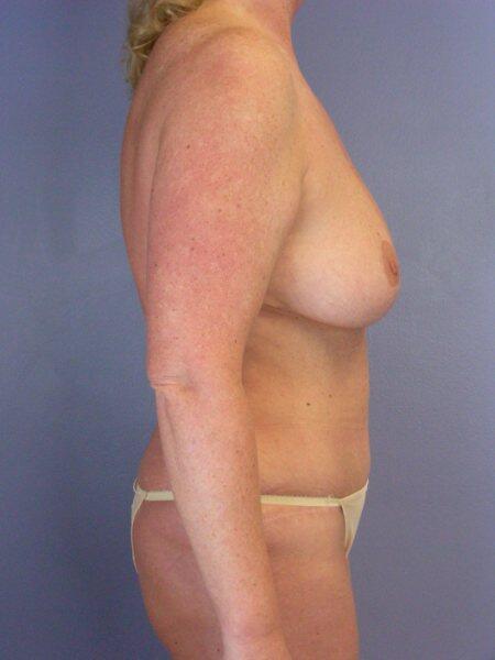 Breast Reduction (for Women) Before & After Image