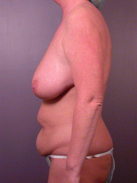 Breast Reduction (for Women) Before & After Image