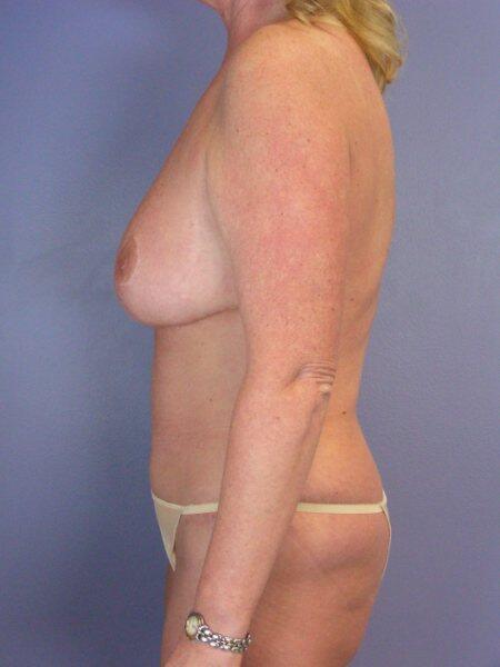 Breast Reduction (for Women) Before & After Image