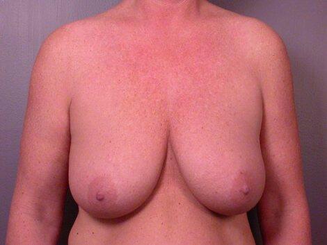 Breast Reduction (for Women) Before & After Image