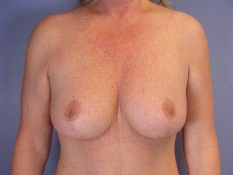 Breast Reduction (for Women) Before & After Image