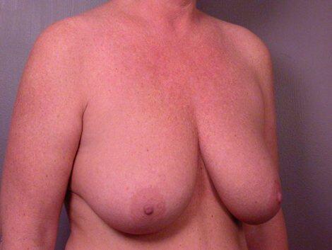 Breast Reduction (for Women) Before & After Image