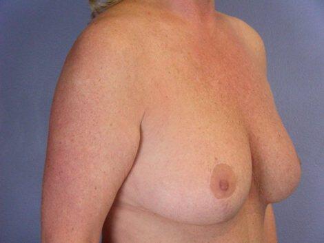 Breast Reduction (for Women) Before & After Image