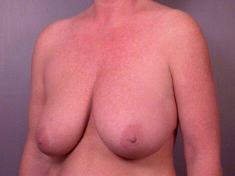 Breast Reduction (for Women) Before & After Image