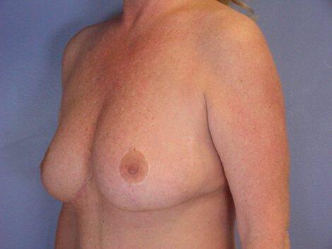 Breast Reduction (for Women) Before & After Image