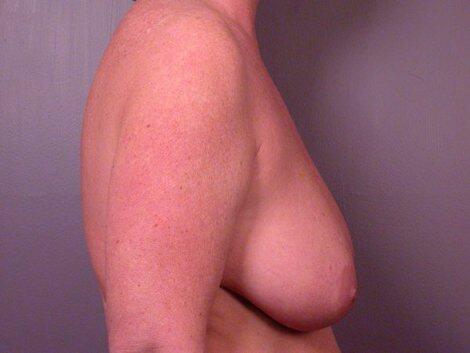 Breast Reduction (for Women) Before & After Image