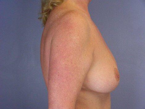 Breast Reduction (for Women) Before & After Image