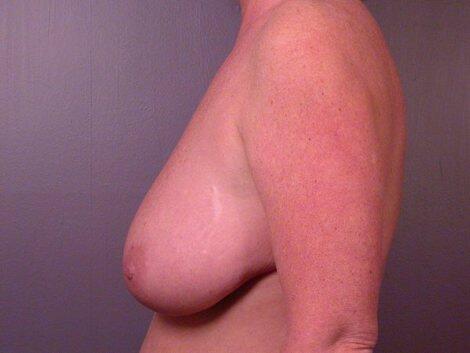 Breast Reduction (for Women) Before & After Image