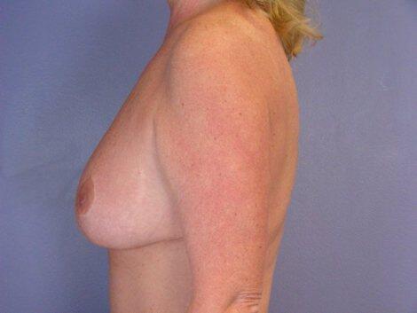 Breast Reduction (for Women) Before & After Image