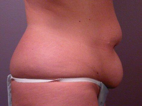 Breast Reduction (for Women) Before & After Image