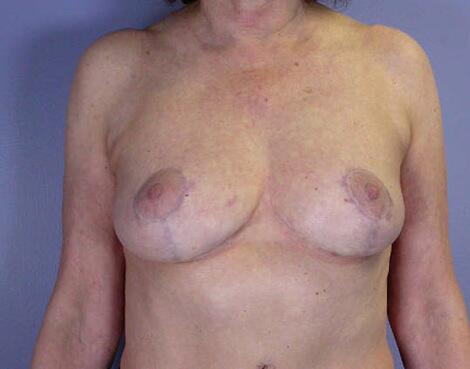 Breast Reduction (for Women) Before & After Image