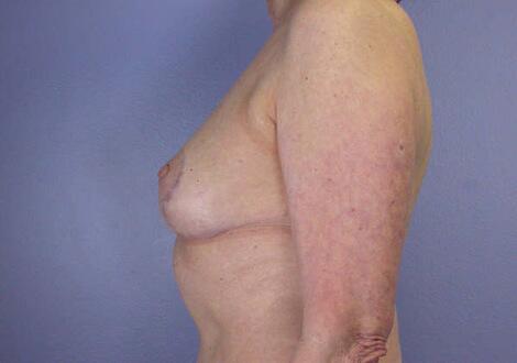 Breast Reduction (for Women) Before & After Image