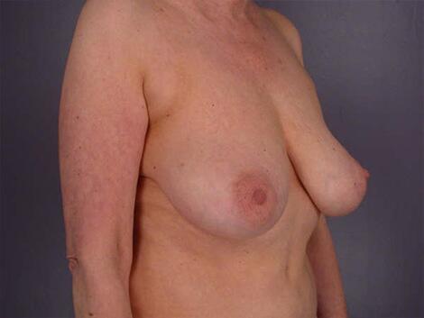 Breast Reduction (for Women) Before & After Image