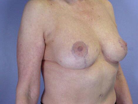 Breast Reduction (for Women) Before & After Image