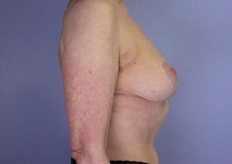 Breast Reduction (for Women) Before & After Image