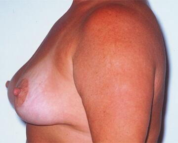 Breast Reduction (for Women) Before & After Image