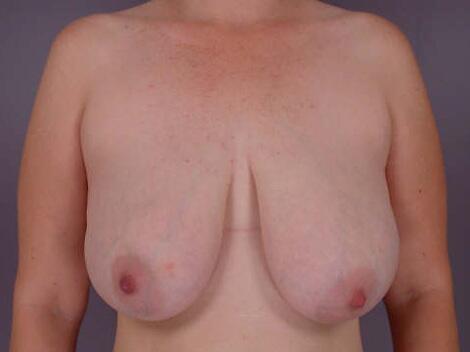 Breast Reduction (for Women) Before & After Image