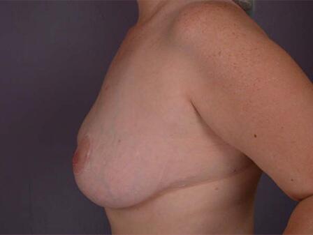 Breast Reduction (for Women) Before & After Image