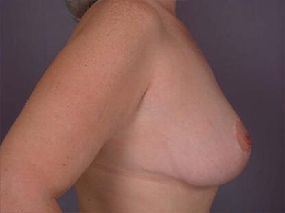 Breast Reduction (for Women) Before & After Image