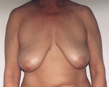 Breast Reduction (for Women) Before & After Image