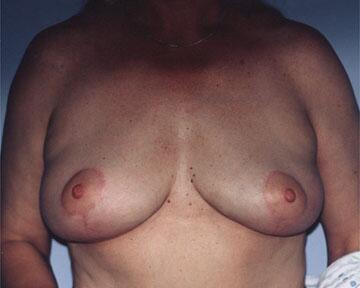 Breast Reduction (for Women) Before & After Image