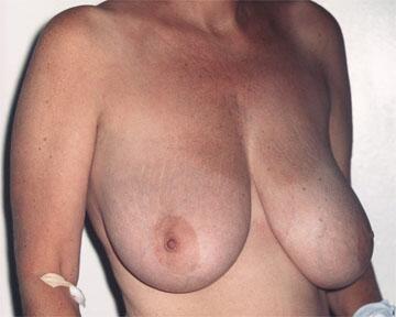 Breast Reduction (for Women) Before & After Image