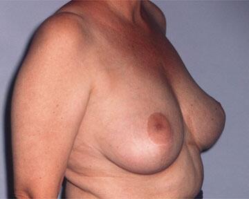 Breast Reduction (for Women) Before & After Image