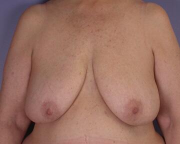 Breast Reduction (for Women) Before & After Image