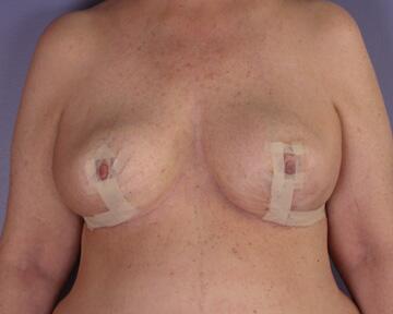 Breast Reduction (for Women) Before & After Image