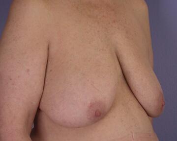 Breast Reduction (for Women) Before & After Image