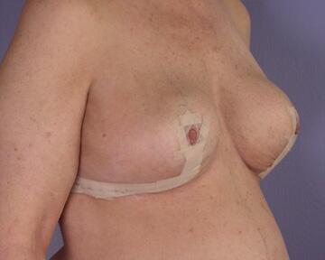 Breast Reduction (for Women) Before & After Image