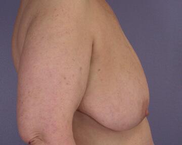 Breast Reduction (for Women) Before & After Image