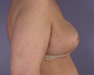 Breast Reduction (for Women) Before & After Image