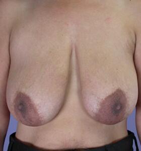 Breast Reduction (for Women) Before & After Image