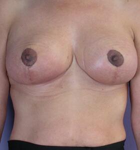 Breast Reduction (for Women) Before & After Image