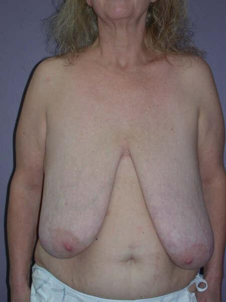 Breast Reduction (for Women) Before & After Image