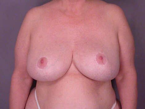 Breast Reduction (for Women) Before & After Image