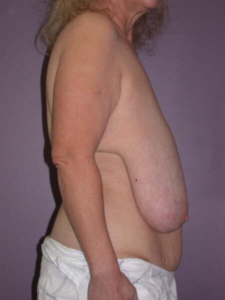 Breast Reduction (for Women) Before & After Image