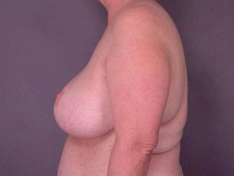 Breast Reduction (for Women) Before & After Image