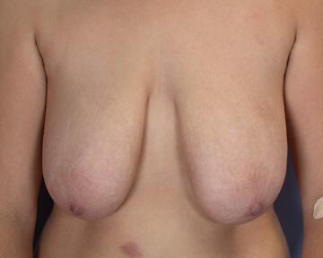 Breast Reduction (for Women) Before & After Image