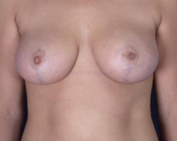 Breast Reduction (for Women) Before & After Image