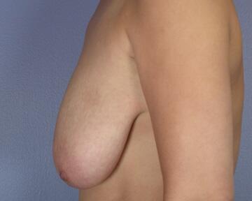 Breast Reduction (for Women) Before & After Image