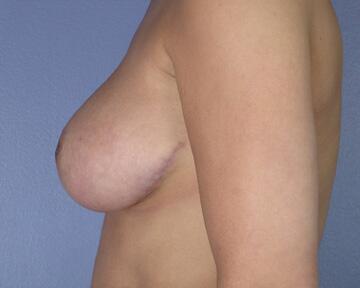 Breast Reduction (for Women) Before & After Image