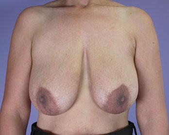 Breast Reduction (for Women) Before & After Image