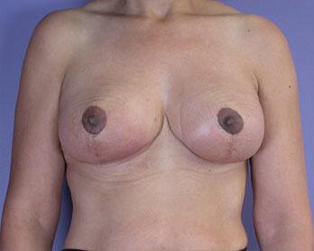 Breast Reduction (for Women) Before & After Image