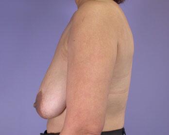 Breast Reduction (for Women) Before & After Image